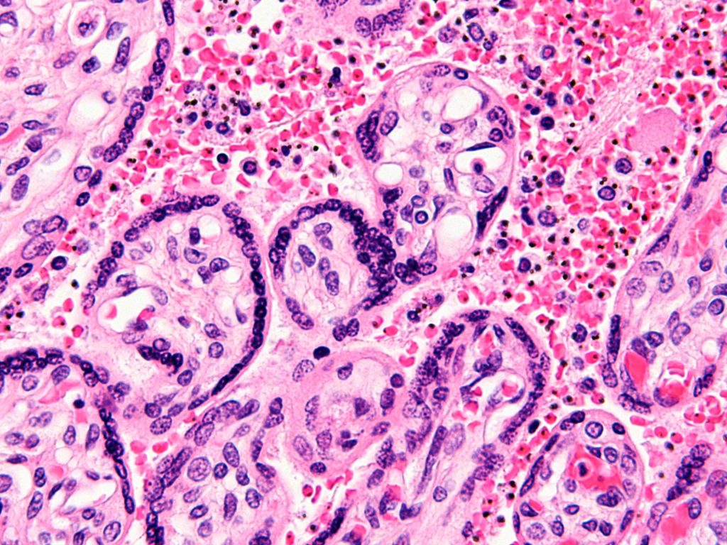 Maternal_malaria_placenta_-_cropped_-_very_high_mag